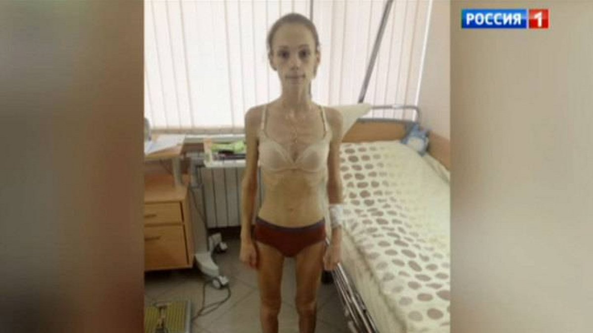 Julia Antipova innan hon åkte till Israel för behandling. 